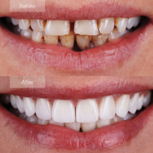 Cosmetic and Resorative Crowns and Veneers