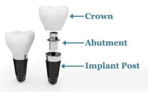 Implant Restorations