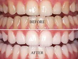 Whitening
